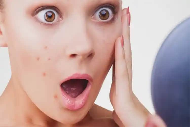 Sivilce Sıkma Sonrası Kızarıklık Nasıl Azaltılır ve Cilt Sağlığı Korunur