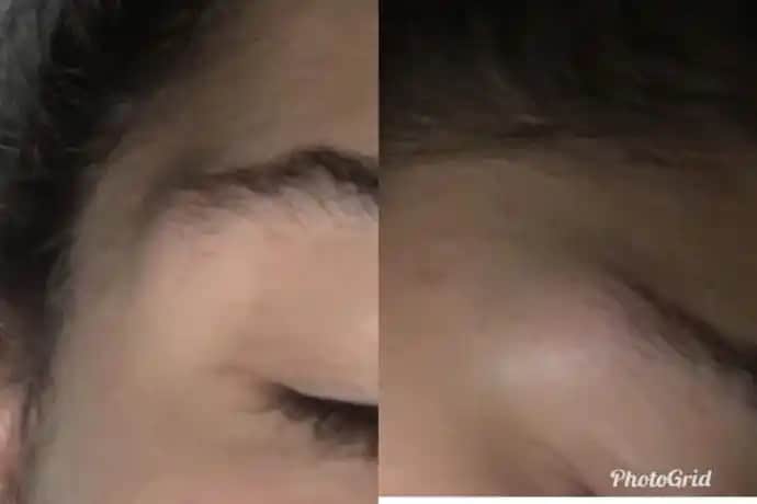 Sivilce Şişmesinin Nedenleri ve Hafifletici Yöntemler Hakkında Bilgi