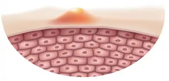 Sivilce Sorunu ve Çözüm Yöntemleri: Kozmetik ve Sağlık Yaklaşımlarıyla Temiz Cilt