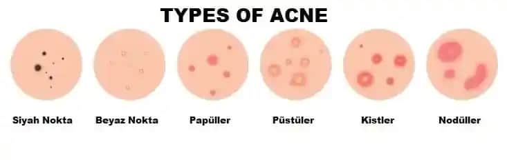 Sivilce Tipleri ve Cilt Sağlığına Yönelik Uygun Bakım Yöntemleri