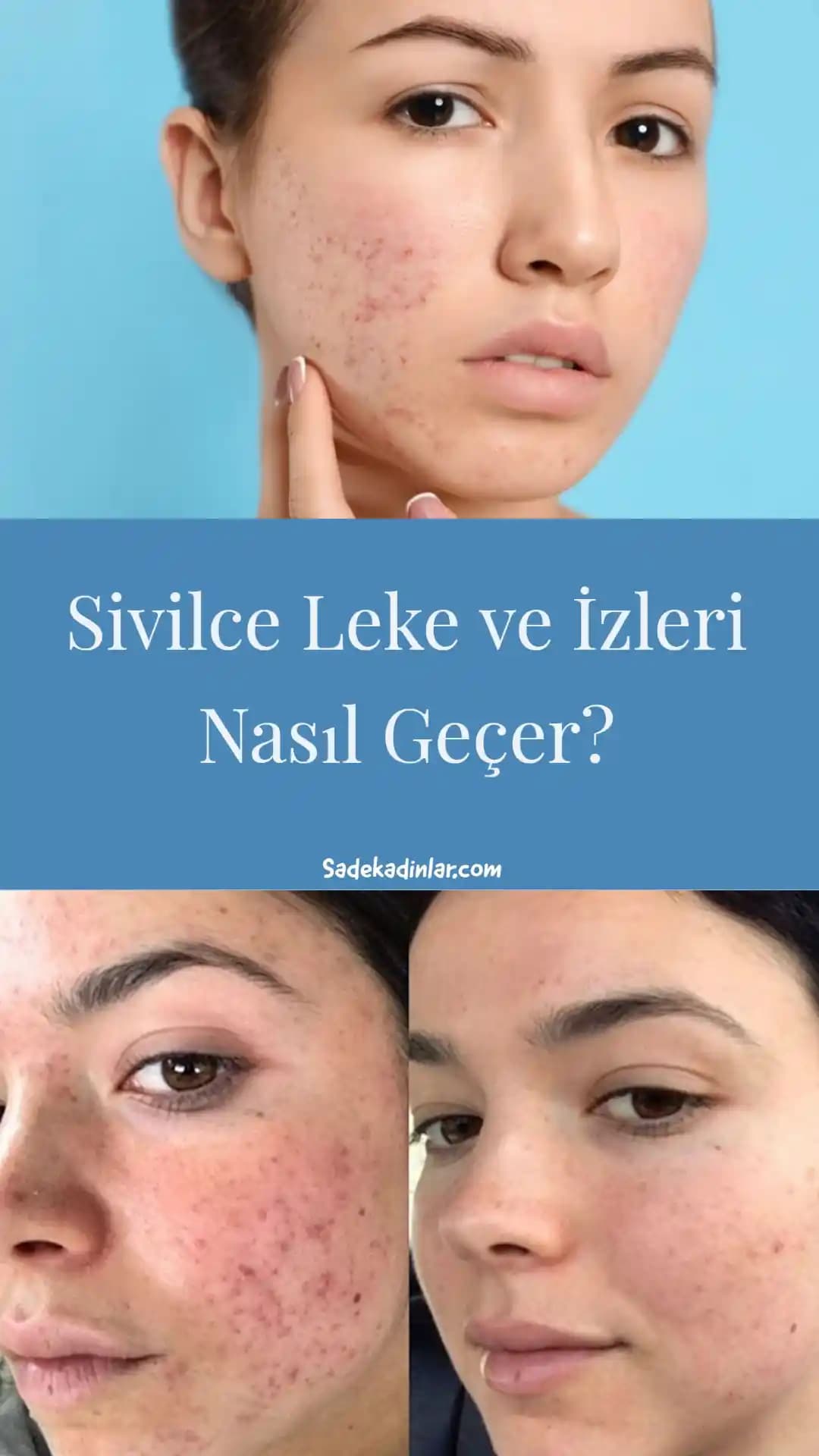Sivilce ve Lekelerin Farkları, Nedenleri ve Etkili Çözüm Yolları