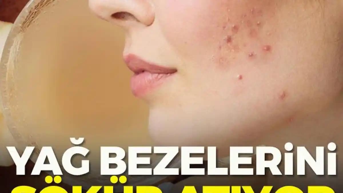 Sivilce Yağ Bezi Nedir, Neden Oluşur ve Etkili Tedavi Yöntemleri Nelerdir