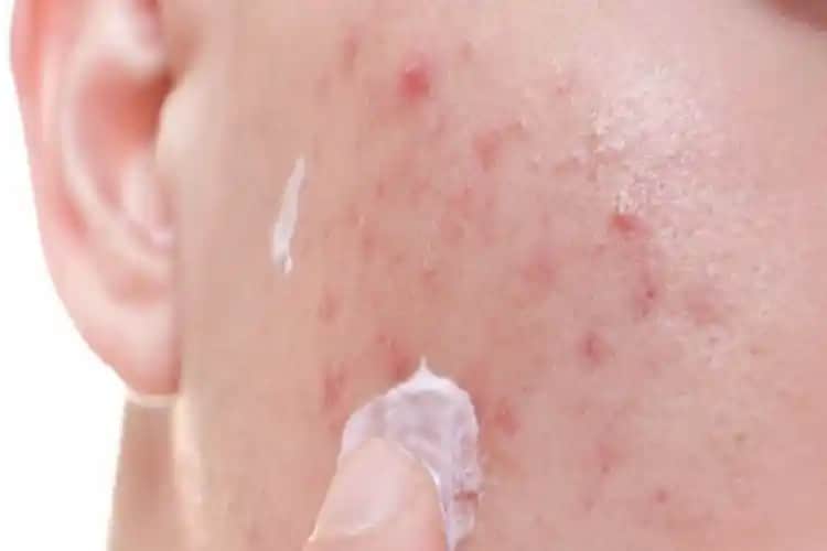 Sivilce Yaralarına Ne Sürülür Cilt Bakımında Etkili ve Güvenilir Yöntemler