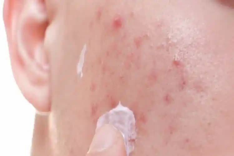 Sivilce Yaralarına Ne Sürülür Cilt Bakımında Etkili ve Güvenilir Yöntemler