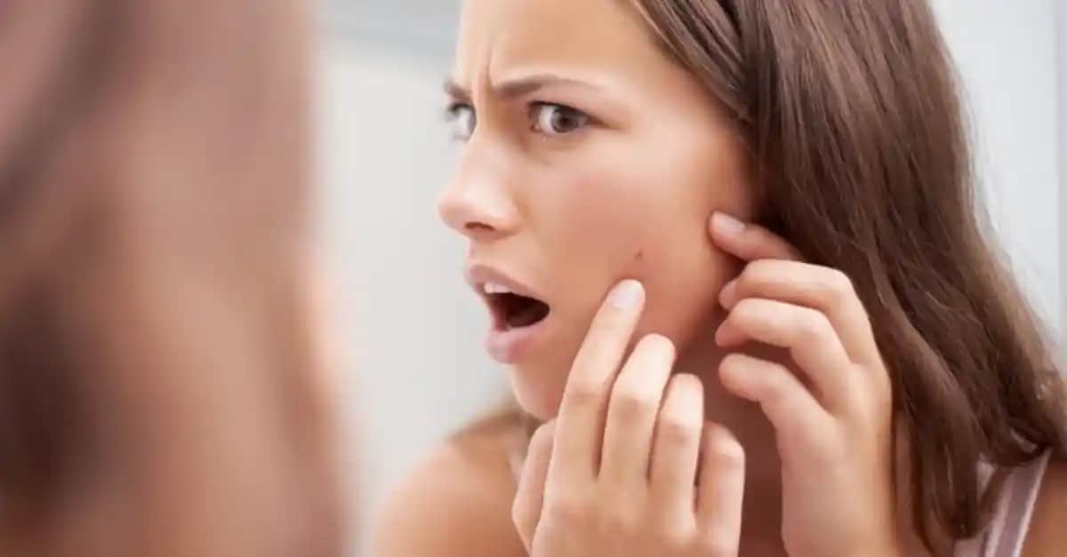 Sivilce Yok Etme Yöntemleri ve Kalıcı Cilt Temizliği İçin Bilmeniz Gerekenler