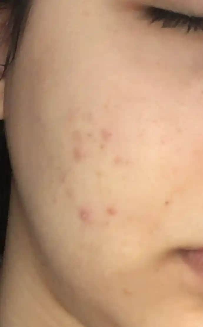 Sivilceler Neden Uzun Süre Geçmiyor ve Etkili Çözüm Yolları