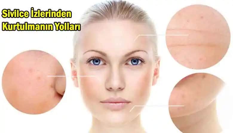 Sivilcelere Karşı Etkili ve Doğal Çözüm Yöntemleri ile Cilt Sağlığınızı Koruyun