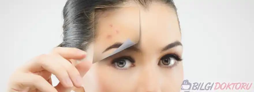 Sivilceleri Önlemek İçin Etkili Cilt Bakım Yöntemleri ve Doğal Çözümler