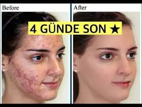 Sivilcelerin Artış Nedenleri ve Cilt Sağlığını Koruma Yöntemleri