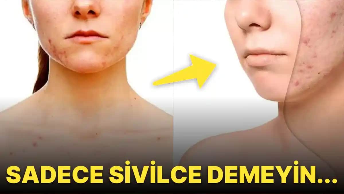 Sivilcelerin Çıkma Nedenleri ve Bilinçli Cilt Bakımı İçin Temel Bilgiler