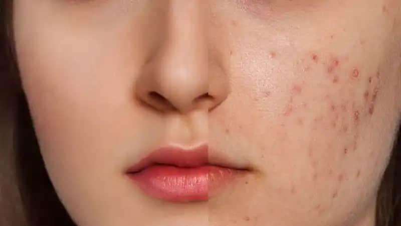 Sivilcelerle Mücadele ve Cilt Bakımı İpuçları: Etkili Yöntemler ve Doğal Çözümler