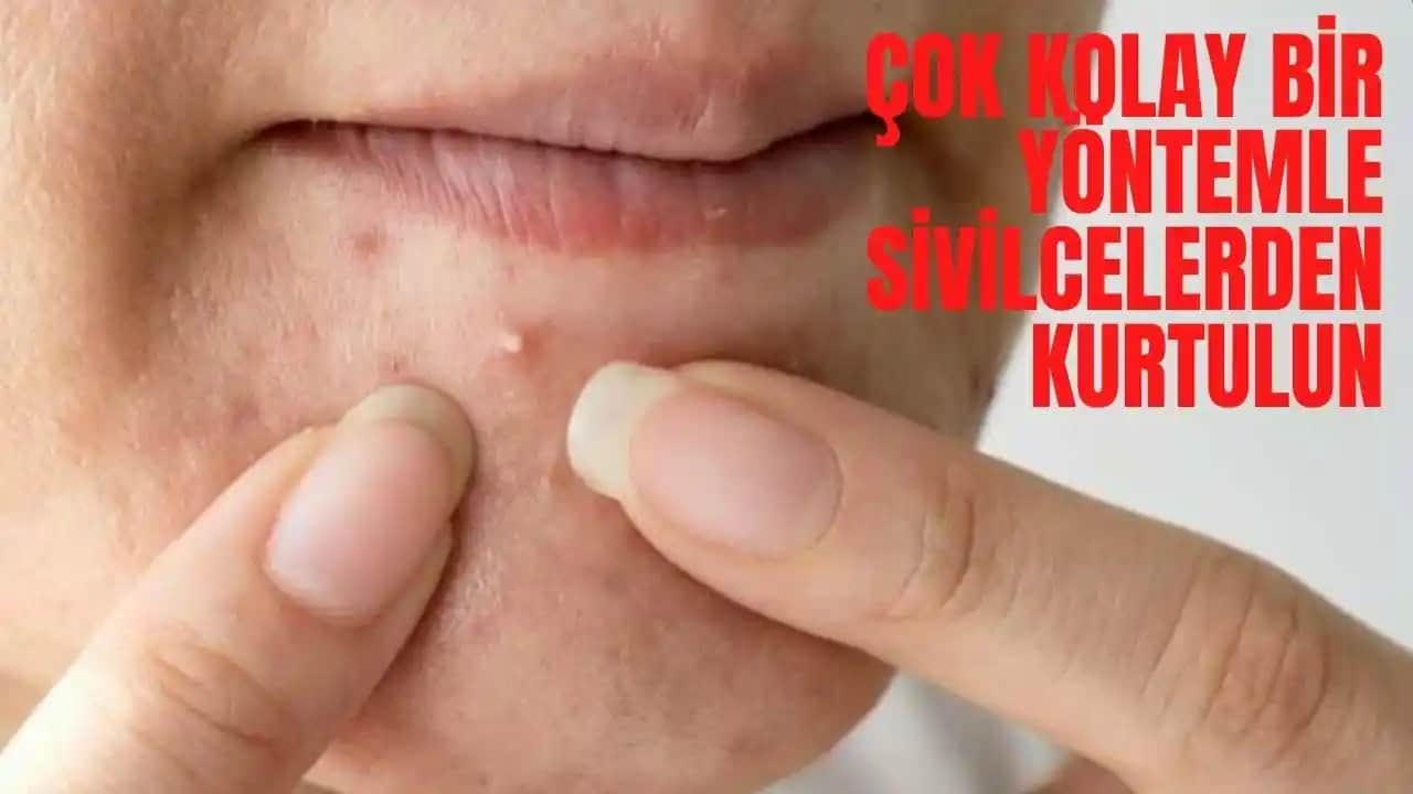 Sivilcelerle Mücadele Yolları: Doğal ve Profesyonel Çözüm Tavsiyeleri