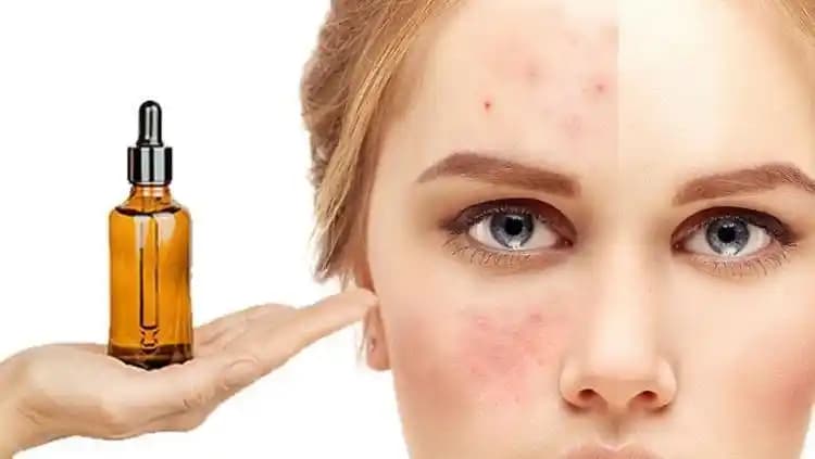 Sivilceye Karşı Doğal Yağlar: Etkili ve Güvenli Cilt Bakımı Çözümleri