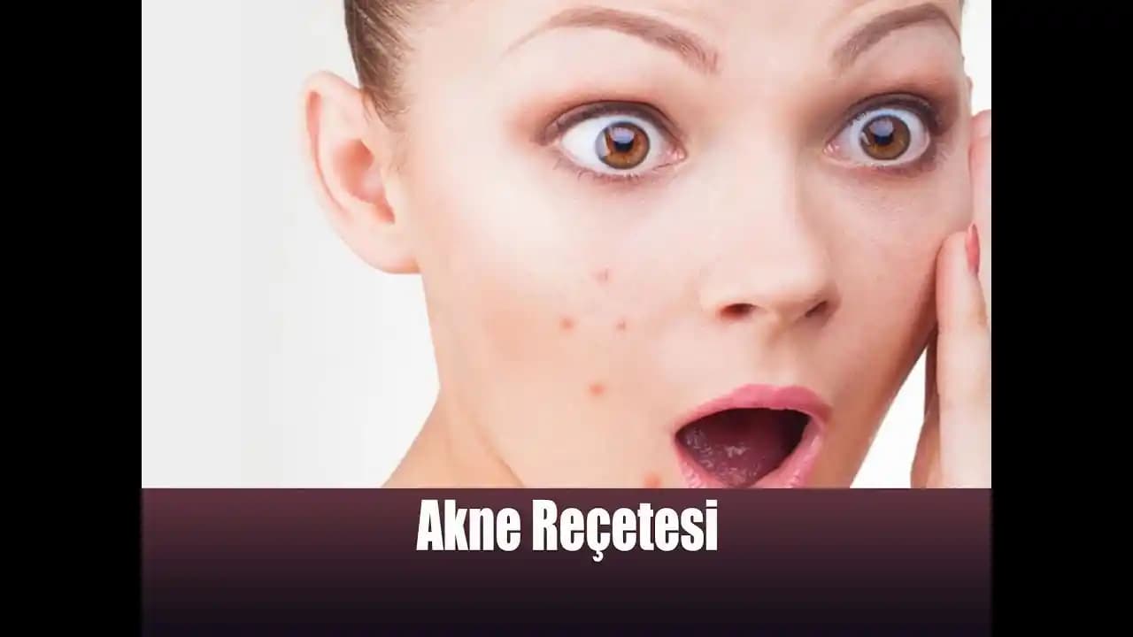 Sivilceye Karşı Sağlıklı Beslenme Rehberi: Cilt Sağlığını Destekleyen Diyet İpuçları