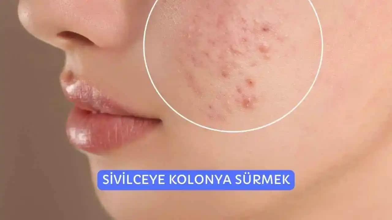 Sivilceye Macun Sürmek: Tehlikeleri ve Güvenli Cilt Bakım Yöntemleri
