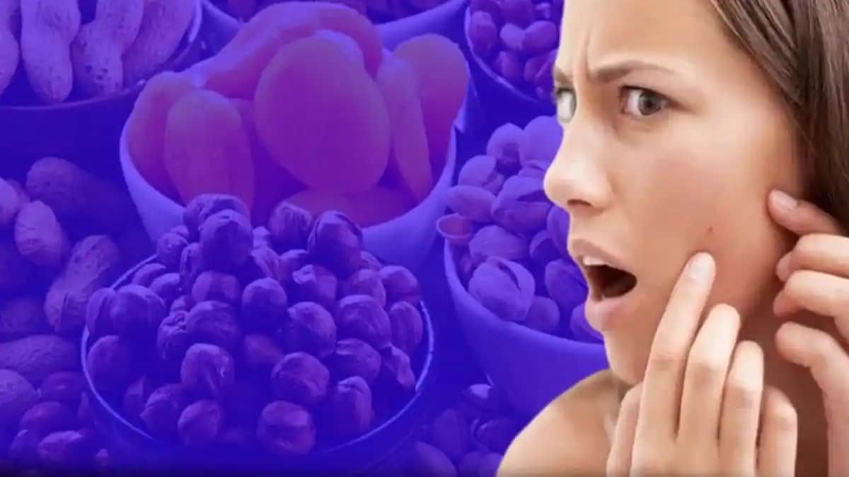 Sivilceyi Tetikleyen Yiyecekler ve Cilt Sağlığına Etkileri Analizi