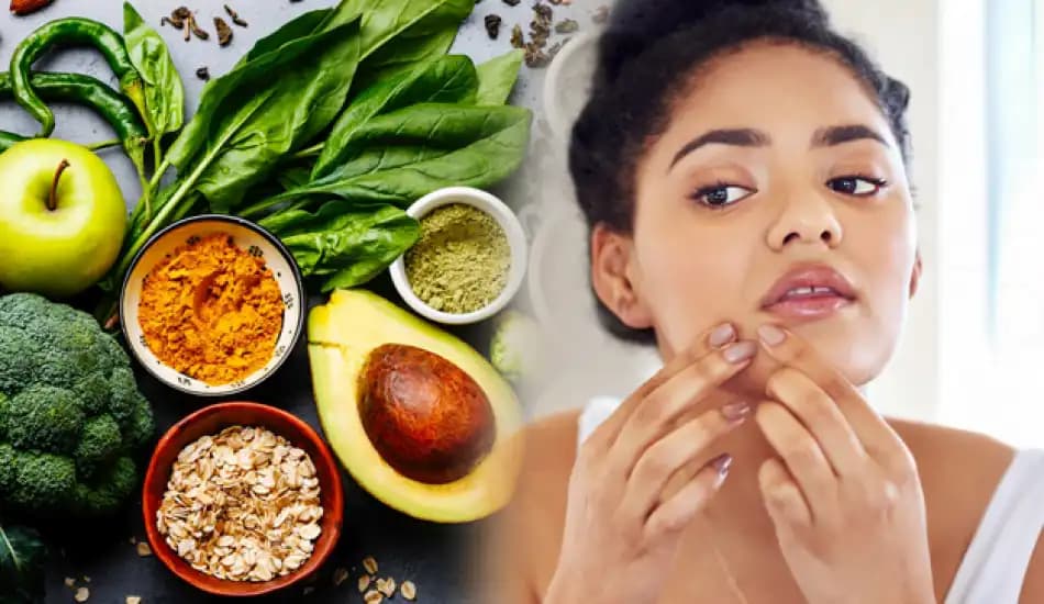 Sivilceyle Mücadelede Doğru Beslenme Yöntemleri ve Tavsiyeleri