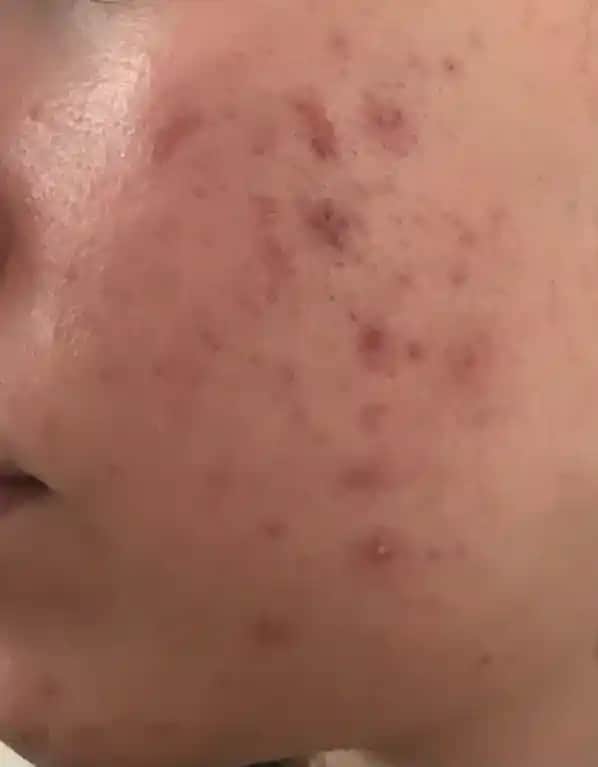 Sivilceyle Mücadelede Etkili Kozmetik Yaklaşımlar ve Cilt Bakımı İpuçları