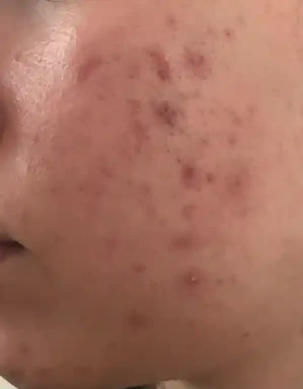 Sivilceyle Mücadelede Etkili Kozmetik Yaklaşımlar ve Cilt Bakımı İpuçları