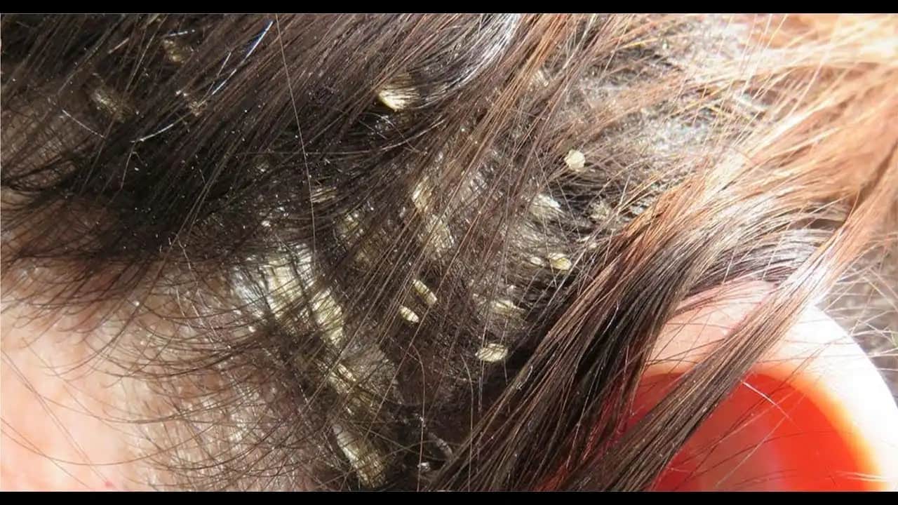 Siyah Kepekle Mücadelede Bilinçli Yaklaşımlar ve Etkili Çözümler