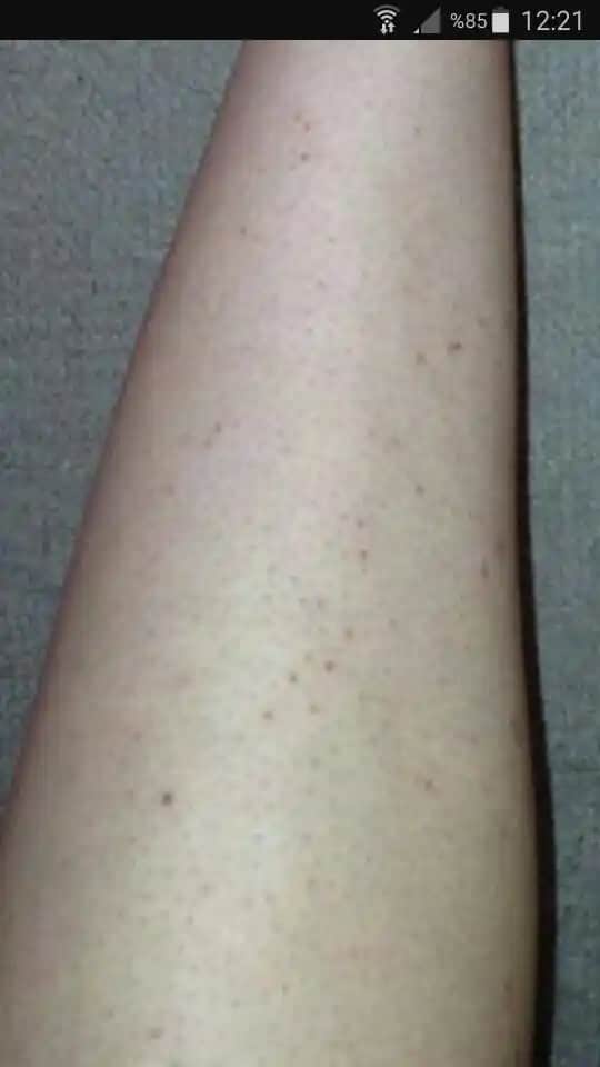 Siyah Kıl Kökleriyle Mücadele ve Cilt Bakımında Etkili Yöntemler