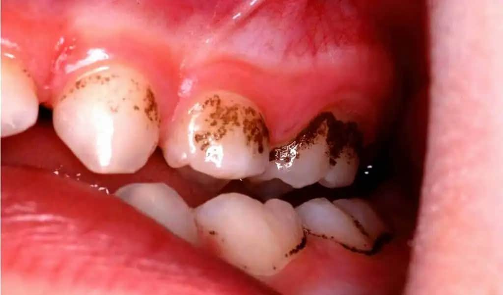 Siyah Lekelerin Nedenleri ve Kozmetik Çözüm Yöntemleri Hakkında Kapsamlı Bilgi