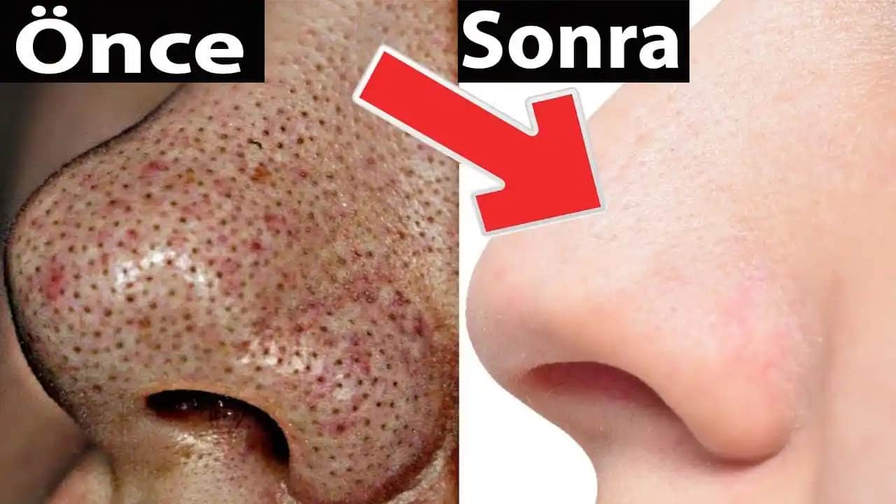 Siyah Nokta Lekeleri Nasıl Geçer Cilt Sağlığı İçin En Etkili Yöntemler ve Bakım İpuçları