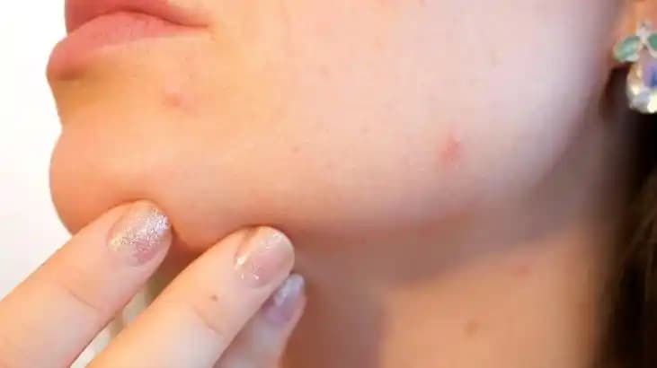 Siyah Nokta Sıkma ve Doğru Cilt Bakımı Yöntemleri Hakkında Bilgilendirici Rehber