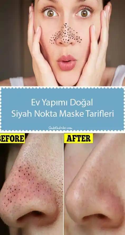 Siyah Noktalardan Kurtulmanın Yolları: Doğal ve Etkili Cilt Bakım Yöntemleri