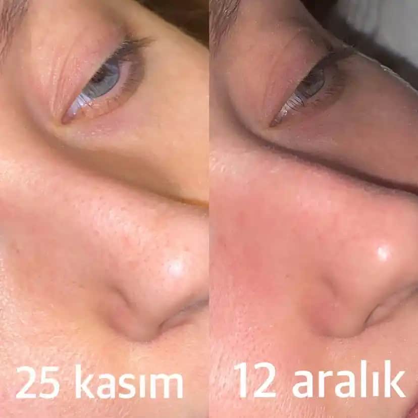 Siyah Noktalarla Mücadele Yöntemleri: Etkili ve Güvenilir Cilt Temizliği Çözümleri