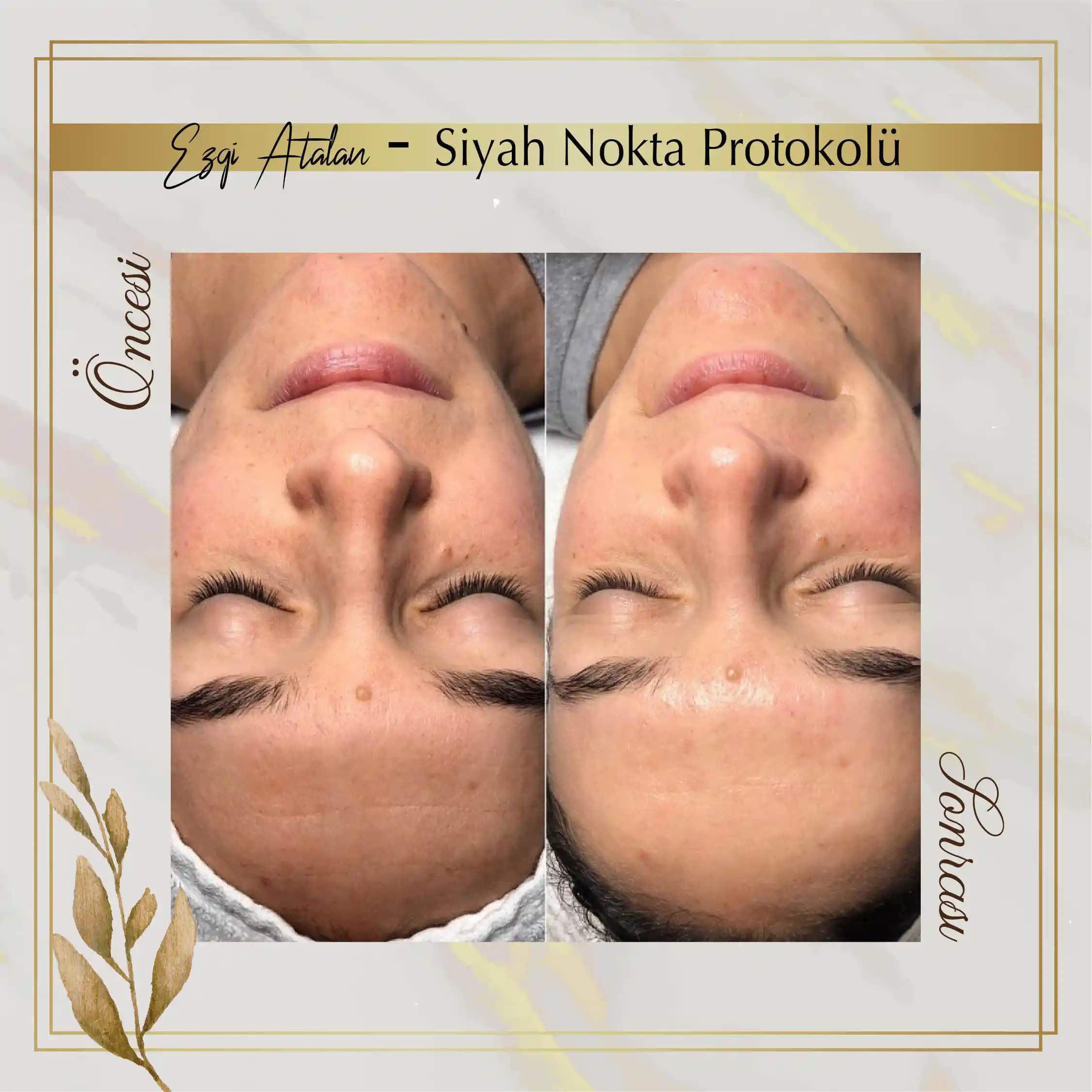 Siyah Noktalarla Mücadelede Etkili ve Güvenilir Cilt Bakımı Yöntemleri