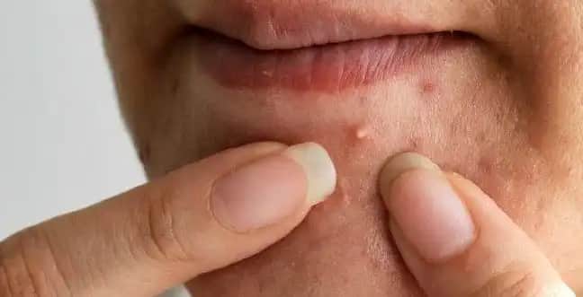 Siyah Sivilce Nedenleri ve Cilt Sağlığı İçin Etkili Çözüm Yöntemleri