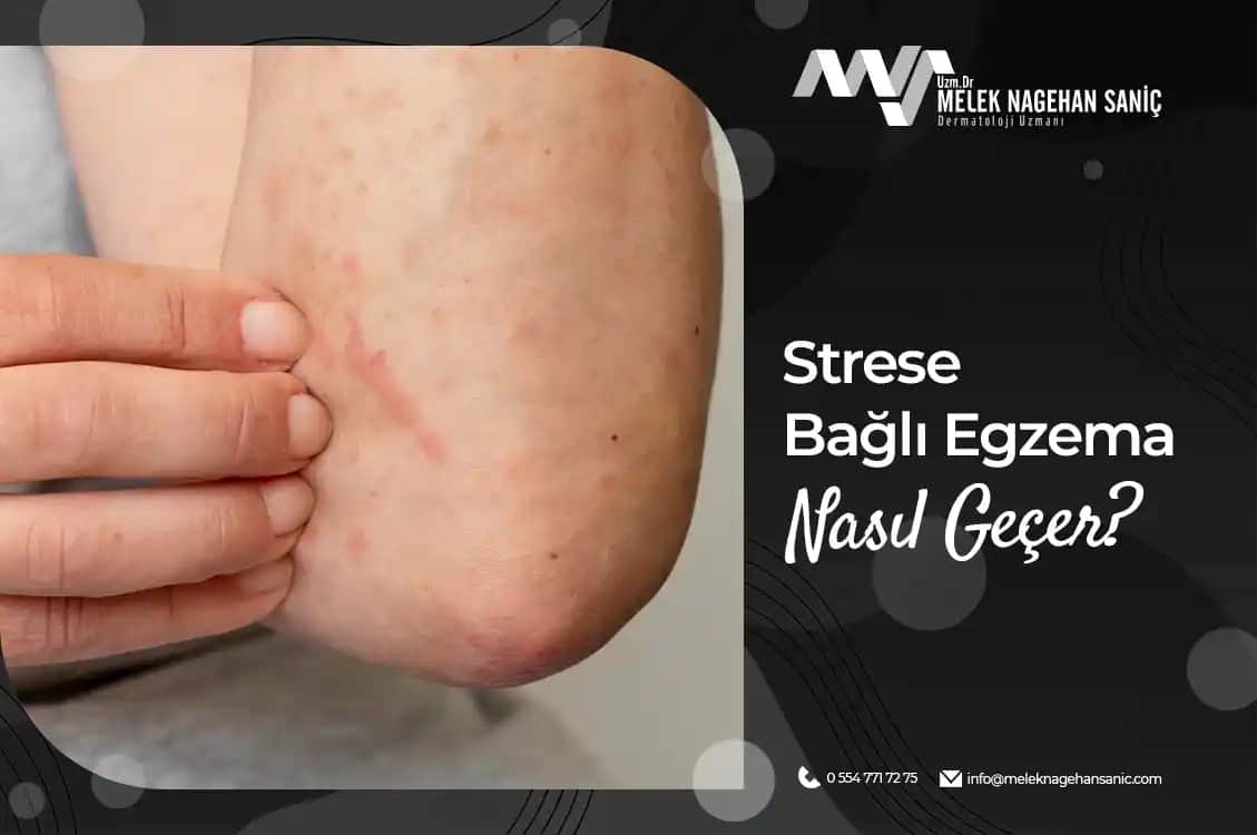 Stres ve Boyun Egzaması: Cilt Sağlığını Koruma Yöntemleri ve Önlemler