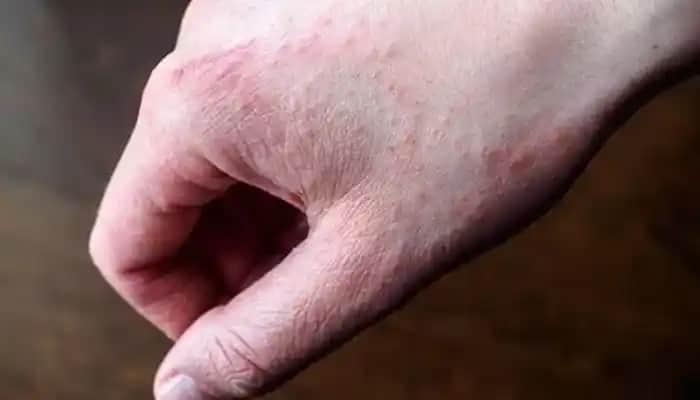 Strese Bağlı Egzama Nedir, Belirtileri, Nedenleri ve Etkili Tedavi Yöntemleri