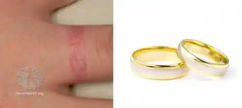 Takı Alerjisi Nedir, Belirtileri ve Güvenli Kullanım Yöntemleri