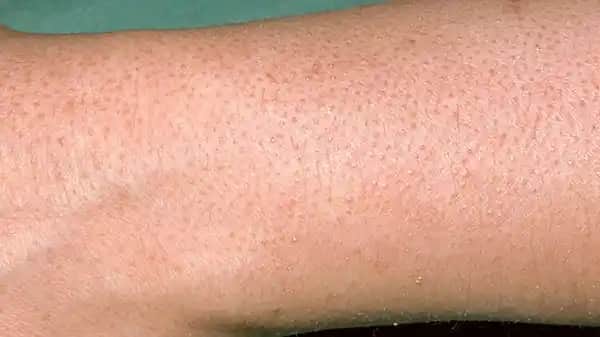 Tavuk Derisi ve Çilek Bacak: Kozmetik Bakım ve Tedavi Yöntemleri Hakkında Bilgi