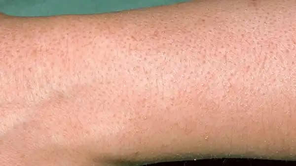 Tavuk Derisi ve Çilek Bacak: Kozmetik Bakım ve Tedavi Yöntemleri Hakkında Bilgi