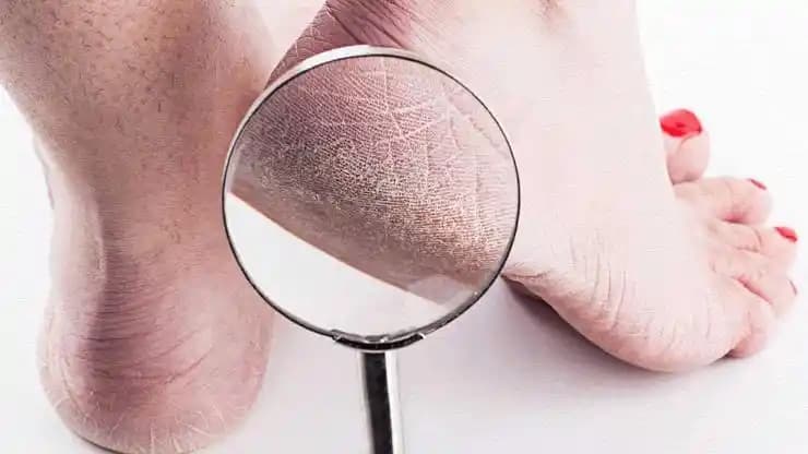 Topuk Çatlaklarının Nedenleri, Önleme Yöntemleri ve Doğal Çözüm Tavsiyeleri