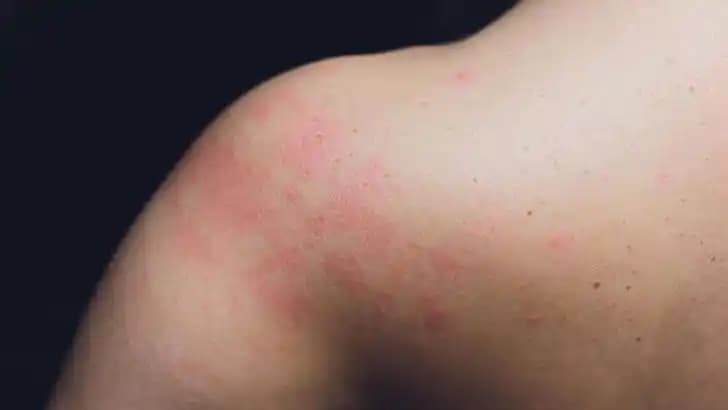 Tüm Vücutta Kızarıklıkların Nedenleri Belirtileri ve Tedavi Yöntemleri