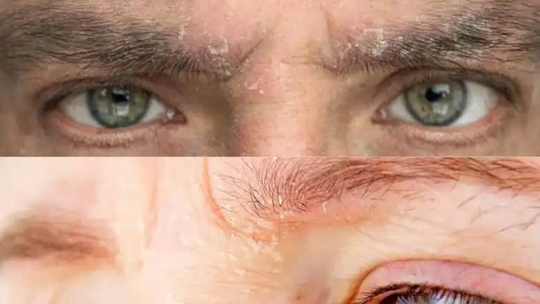 Vücut Kepeklenmesi Neden Olur ve Sağlıklı Cilt İçin Alınması Gereken Önlemler