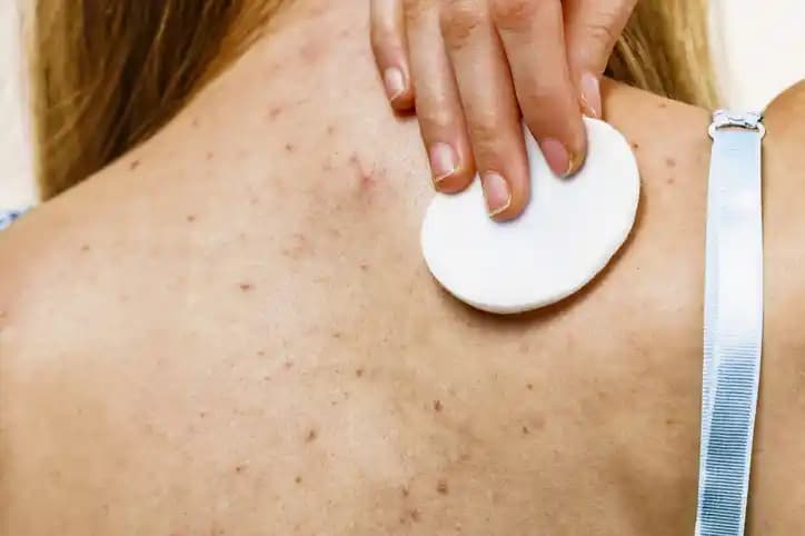 Vücutta Büyük Sivilce Çıkmasının Nedenleri ve Etkili Tedavi Yöntemleri