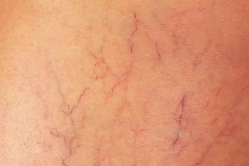 Vücutta Damar Çatlaması Nedenleri Belirtileri ve Kozmetik Çözüm Yöntemleri