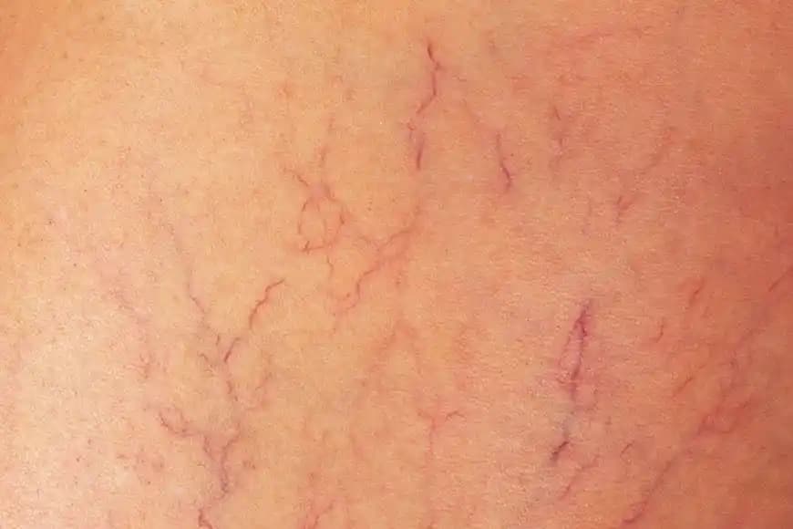 Vücutta Damar Çatlaması Nedenleri Belirtileri ve Kozmetik Çözüm Yöntemleri