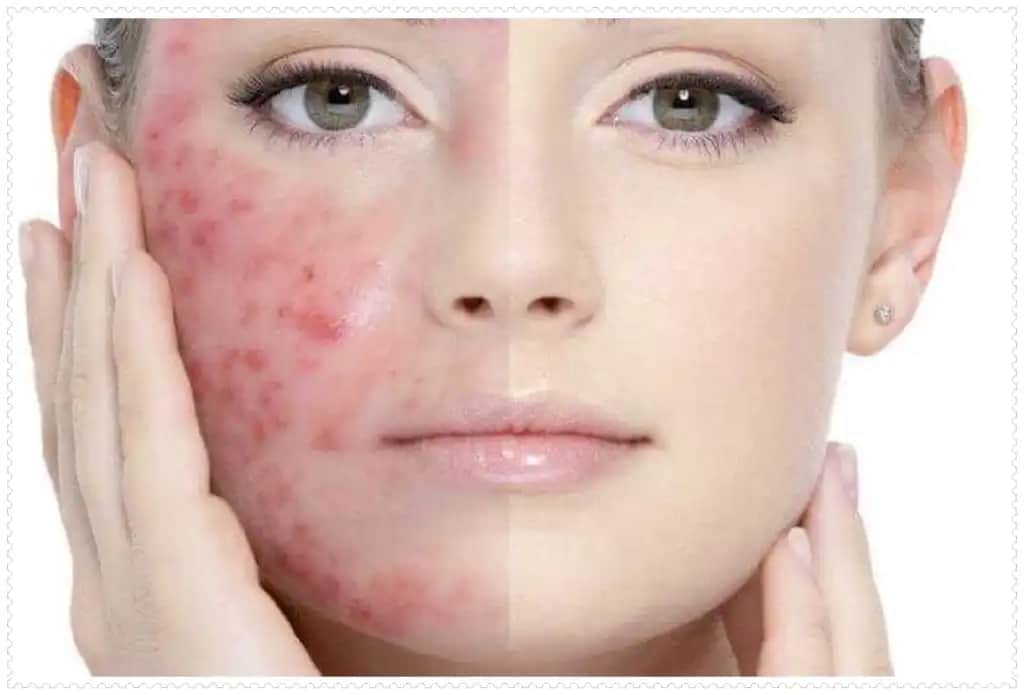 Vücutta İltihaplı Sivilceler: Nedenleri, Belirtileri ve Etkili Çözüm Yöntemleri