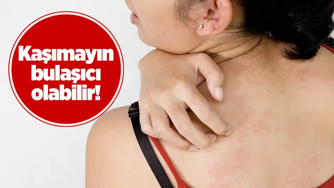 Vücutta Kabarcıkların Sebepleri ve Cilt Bakımında Dikkat Edilmesi Gerekenler