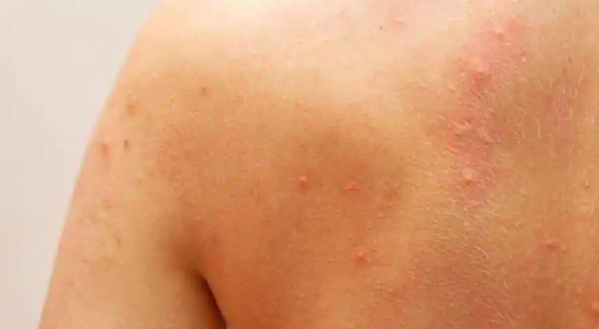 Vücutta Kaşınan Kabarcıklar ve Kozmetik Bakım İpuçları