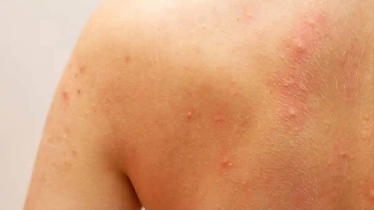 Vücutta Kaşıntı, Kızarıklık ve Kabarmanın Nedenleri ve Doğru Bakım Yöntemleri