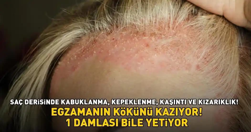 Vücutta Kepeklenmenin Nedenleri, Etkileri ve Etkili Çözüm Yolları Analizi