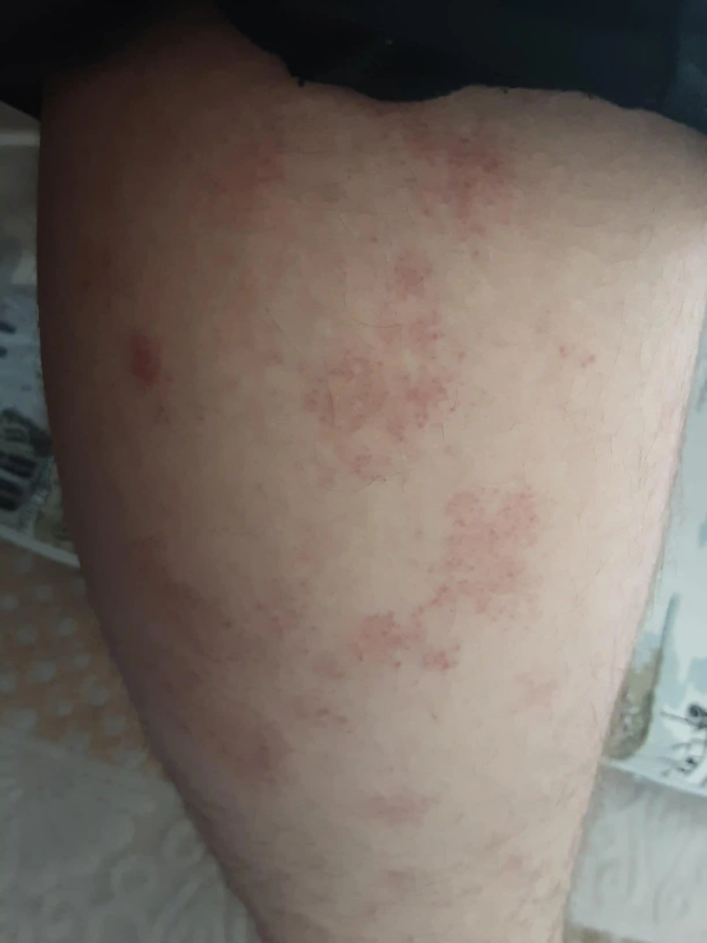 Vücutta Kırmızı Kabarıklıkların Nedenleri ve Kozmetik Ürünlerle İlişkisi