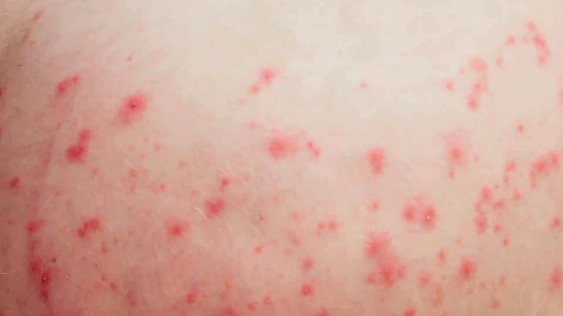 Vücutta Kırmızı Noktalar Neden Oluşur ve Tedavi Yöntemleri Nelerdir